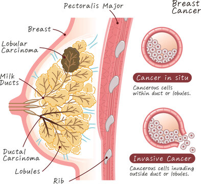 Breast cancer・IDC・ILC・DCIS・LCIS・illustration・乳癌・イラスト