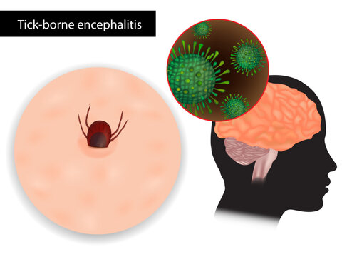 Tick-borne encephalitis or TBE. Viral infectious disease involving the central nervous system. Sheep ticks or Ixodes ricinus