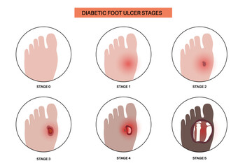 Diabetic Foot Ulcers - obrazy, fototapety, plakaty