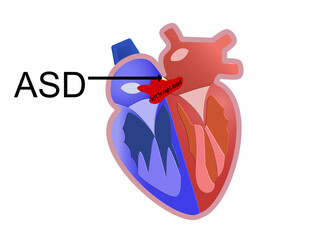 The picture shows atrial septal defect  or ASD and the structure of left to right shunt  that happened from ASD for medical and study congenital heart disease concept 
