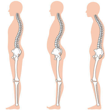 反り腰、骨盤後傾の姿勢　比較