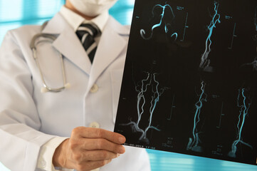 cerebrovascular stroke concept. neurosurgery doctor examining blood vessels x-ray images in the...