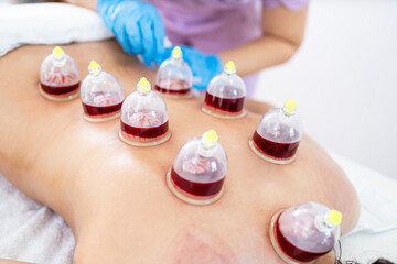 Fototapeta na wymiar Hijama master performs a vacuum blood suction procedure on patient skin.