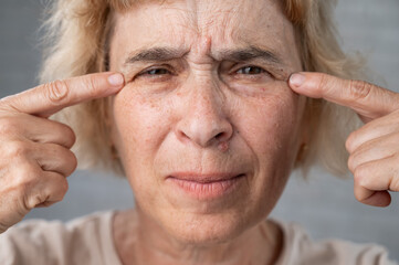 Close-up portrait of an old woman pointing at a wrinkle around her eyes. 