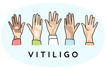 Fototapeta premium Diverse hands of people suffer from vitiligo disease. People struggle with pigmentation on body. World vitiligo day concept. Vector illustration.