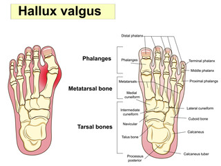 Hallux valgus text. Anatomy. Human foot bones. Signatures, also for clinics - obrazy, fototapety, plakaty