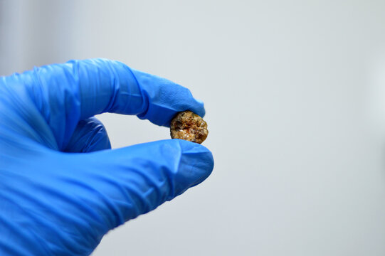A gallstone removed surgically after laparoscopic cholecystectomy, Gallstones are hardened deposits of digestive fluid that can form in gallbladder with two types, cholesterol and pigment stones