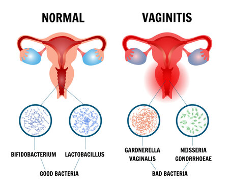 Aerobic vaginitis medical gynecology illustration 
