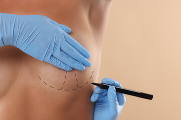 Breast augmentation. Doctor with marker preparing woman for plastic surgery operation against beige...