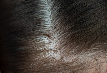 Thin hair spot on Asian woman head. Female pattern hair loss can progress from a widening part to...