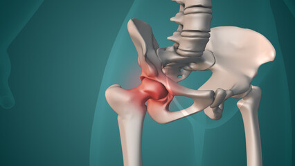  Human painful hip medical concept