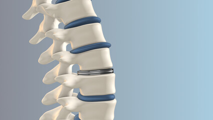 Artificial Disk replacement in the lumbar spine