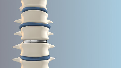 Artificial Disk replacement in the lumbar spine