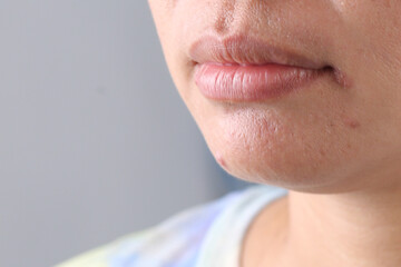 close up of a person looking up  Angular Cheilitis