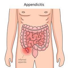 Appendicitis inflammation of the appendix diagram schematic vector illustration. Medical science educational illustration