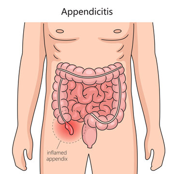 Appendicitis inflammation of the appendix diagram schematic vector illustration. Medical science educational illustration
