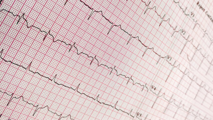 ECG. EKG, Electrocardiogram show Sinus bradycardia pattern. Cardiac fibrillation. Normal 12-lead sinus rhythm ECG. Vital sign. Medical healthcare symbol.