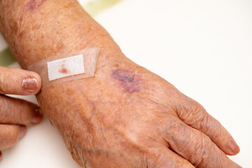 Close up old woman hand, upper limb or arm to the wounded waiting for nurse treatment on wound...