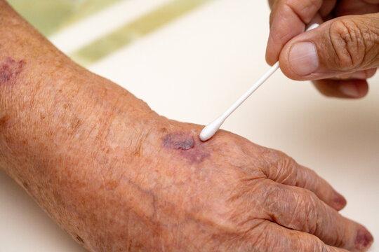 Close up old woman hand, upper limb or arm to the wounded waiting for nurse treatment on wound dressing a bloody and brine of patient.