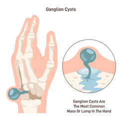 Ganglion cyst. Fluid-filled lump under the skin of a wrist or hand. Synovial