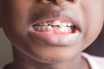 Close up shot of he mouth of a girl child in Nigeria, showing her milk teeth that is about removing...