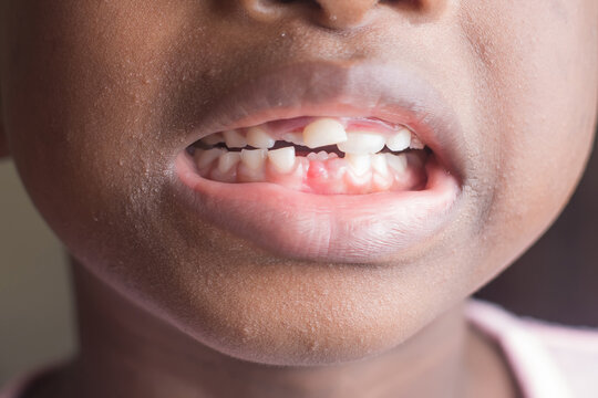 Close up shot of he mouth of a girl child in Nigeria, showing her milk teeth that is about removing and the new ones growing underneath