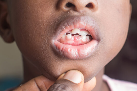 Close up shot of he mouth of a girl child in Nigeria, showing her milk teeth that is about removing and the new ones growing underneath