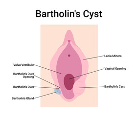 Bartholin's Cyst Medical Vector Illustration