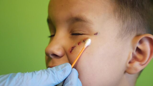 The wound on the boy's face is treated with panthenol foam. Treatment and healing of scratches on the skin.