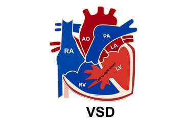 The picture show the structure of congenital heart disease which is ventricular septal defect or VSD and show the left to right shunt of blood that happen from VSD for medical and study 