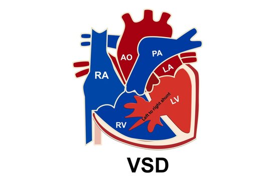  The picture show the structure of congenital heart disease which is ventricular septal defect or VSD and show the left to right shunt of blood that happen from VSD for medical and study 