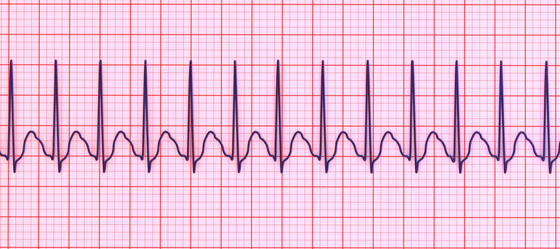 Electrocardiogram displaying supraventricular tachycardia, 3D illustration
