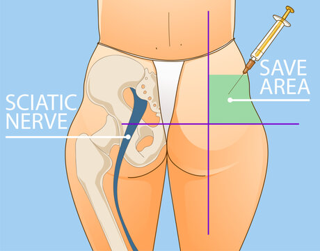 Beauty injections. Non-surgical correction. Save area. Sciatic nerve. Healthcare illustration. Beauty illustration. Vector illustration. 