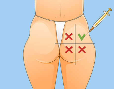 Beauty injections. Non-surgical correction. Save area. Sciatic nerve. Healthcare illustration. Beauty illustration. Vector illustration. 