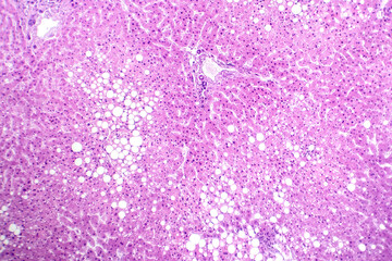 Hepatic steatosis, light micrograph