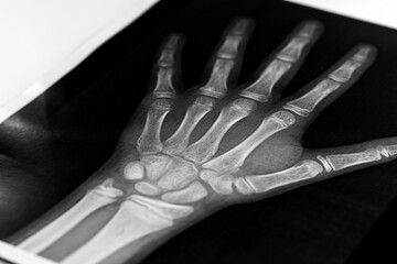 x-ray of the hands, detail of the phalanges and joints,trapeze,scaphoid,Pyramidal,Pisiform,capitate, distal, frontal, proximal, interflaginian, lunate, intercapitate - obrazy, fototapety, plakaty
