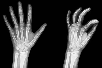 x-ray of the hands, detail of the phalanges and...