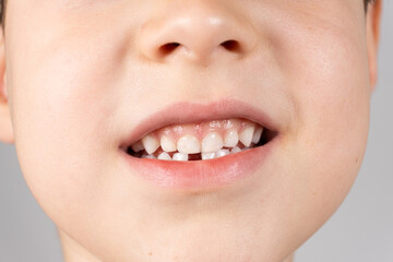 Obraz premium Loss of milk teeth in children. A six-year-old child shows the first baby tooth that has fallen out