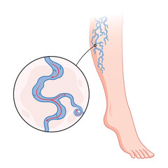 Varicose veins. Blue blood vessel visible through the skin, abnormally swollen leg. Vascular disease diagnostic and treatment. Venous insufficiency medical disease