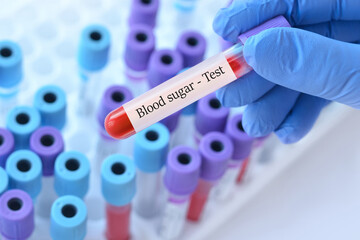 Doctor holding a test blood sample tube with Sugar test on the background of medical test tubes with analyzes.Copy space for text