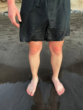 Photo Of Anonymous Man With Sunburn At Beach