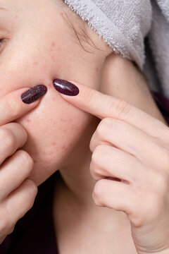 Unrecognisable woman picking pimples