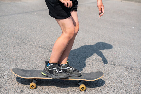 skater with hematoma