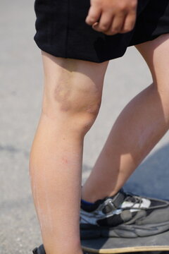 skater with hematoma