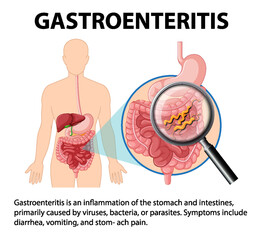 Gastroenteritis: Infection, Inflammation, and Digestive System Symptoms