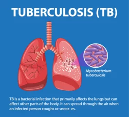 Fototapete Kinder Human Anatomy of Lung with Tuberculosis Infographic