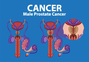 Foto auf Acrylglas Kinder Comparison of Normal and Cancerous Prostate in Infographic