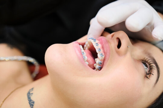 Close up of a patient with braces