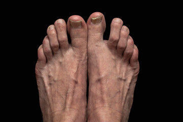 Toenail fungal infection