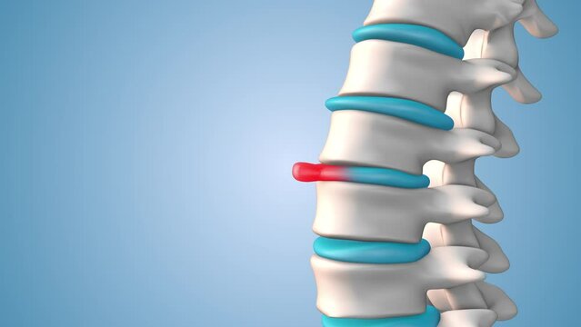 Human spinal disc herniation pain